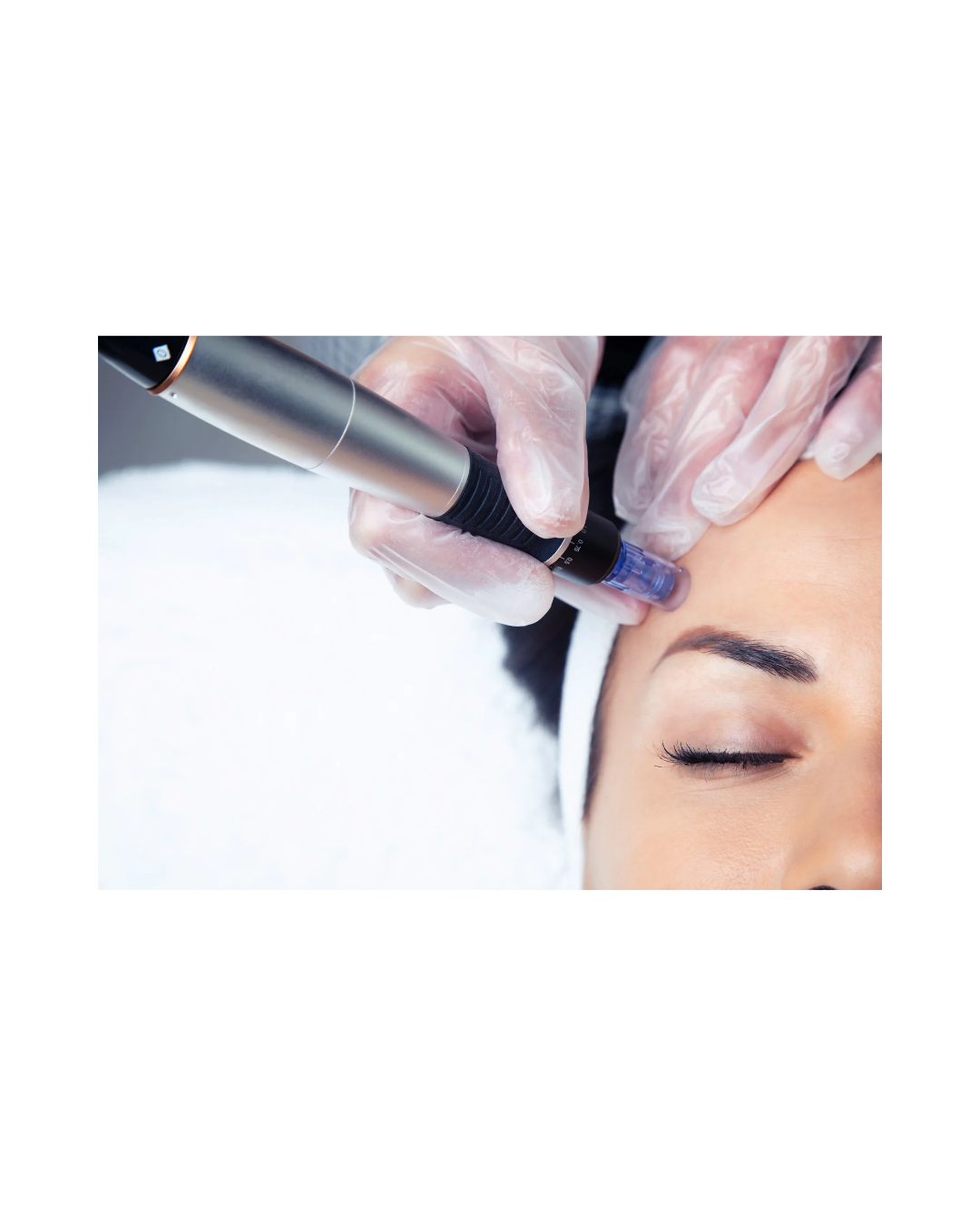 Microneedling Visage – Protocole Professionnel